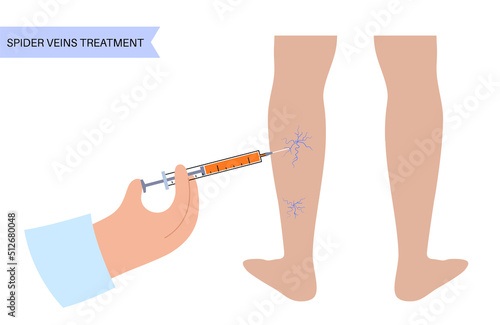 Varicose Injection procedure