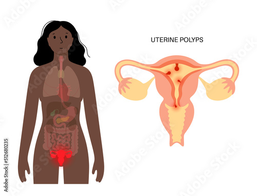 Uterus Polyps Disease