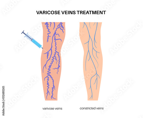 Varicose Injection procedure