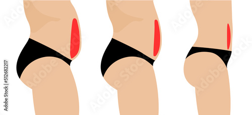 Liposuction fat plastic surgery fat change belly body cellulite shape. Cosmetic surgery vector woman or man illustration
