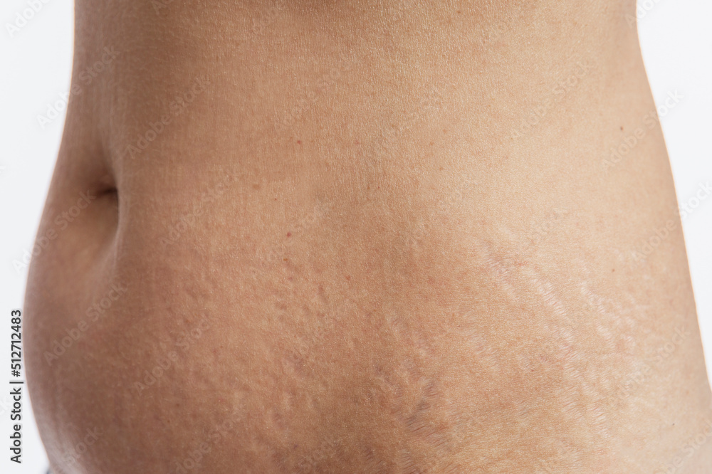 Stretch marks on a woman's abdomen. Consequences of childbirth and weight gain. Close-up. White background. Stretch marks on a woman's abdomen. Consequences of childbirth and weight gain. Close-up. White background.