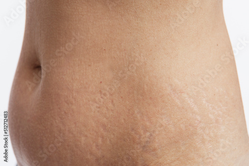 Stretch marks on a woman's abdomen. Consequences of childbirth and weight gain. Close-up. White background.
