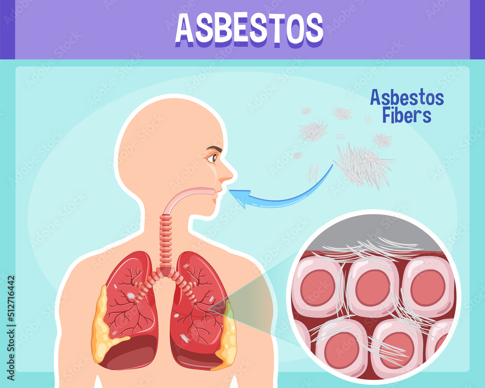 Obraz premium Diagram showing asbestosis in lungs