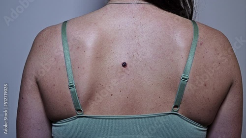 Problematic Skin - back of a young woman with multiple small birthmarks and bumps on the skin with one large seborrheic keratosis photo