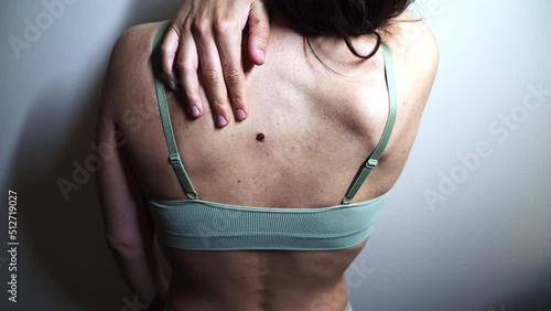 Back of a young woman with multiple small birthmarks and bumps on the skin trying to reach seborrheic keratosis. photo