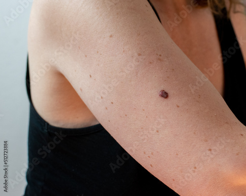 an example of a malignant melanoma skin cancer mole on a woman's arm
