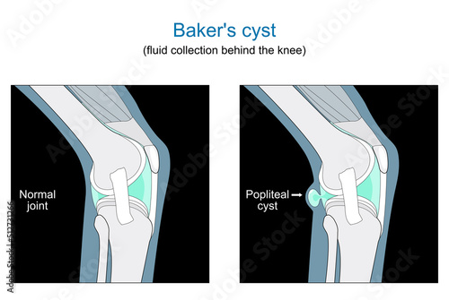 Baker's cyst. knee joint
