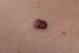 extreme close up of a large mole that was diagnosed as malignant melanoma skin cancer