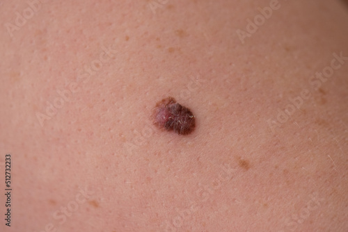 close up of an atypical mole with two colours which was diagnosed as malignant melanoma skin cancer skin cancer  photo