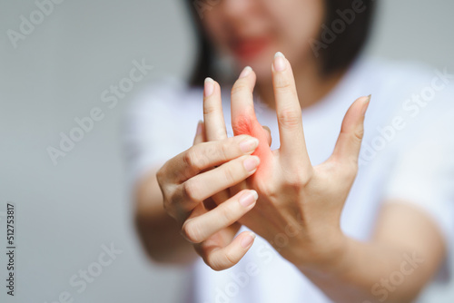 Photo Woman has finger joint pain due to rheumatoid arthritis