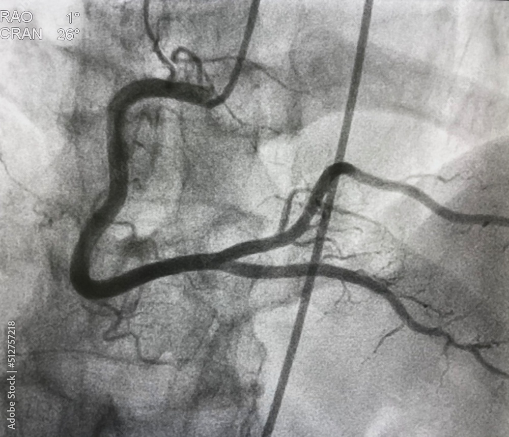Obraz premium Normal right coronary artery (RCA) angiogram.