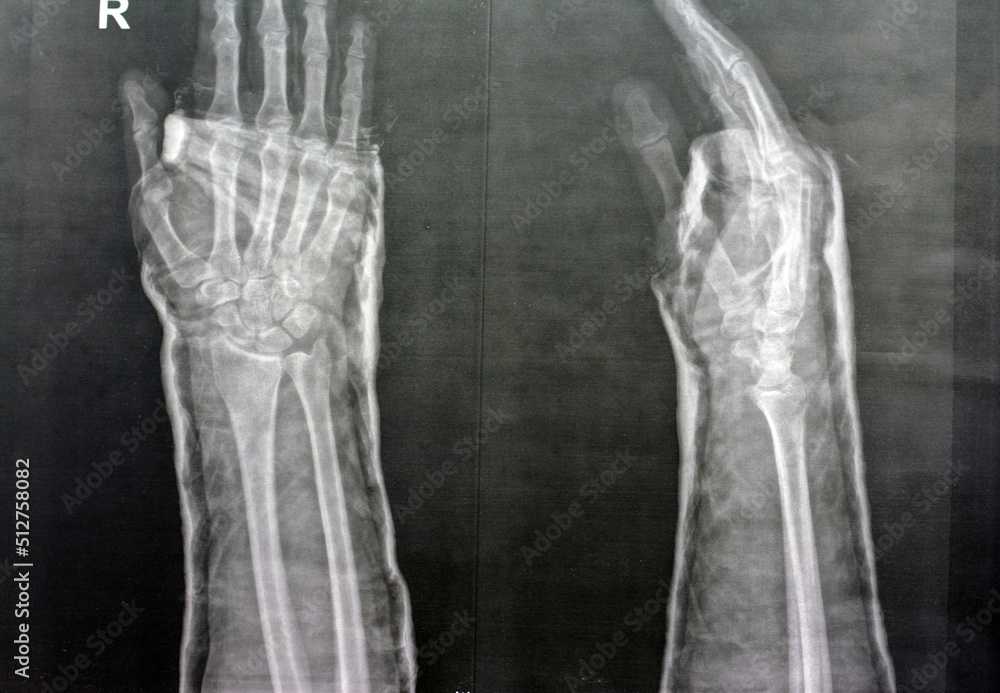 Plain x ray right wrist joint shows right distal radius fracture