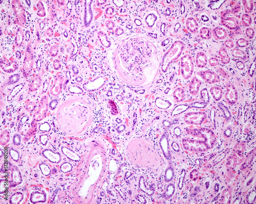 Human kidney. Diabetic nephropathy