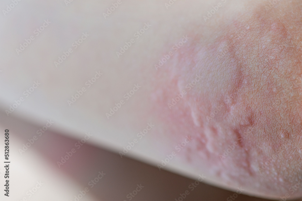 Urticaria On The Skin Red Spots Of An Allergic Reaction On The Skin Of 