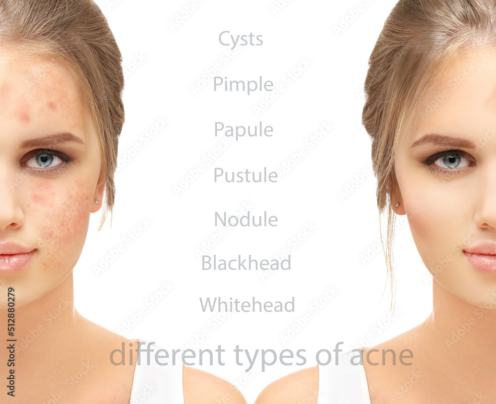 Acne,Skin concern,blemishprone skin and acne, Rosacea,different types