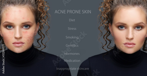 Acne,Skin concern,blemish-prone skin and acne, Rosacea,different types of acne photo