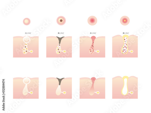 ニキビの種類のイラスト