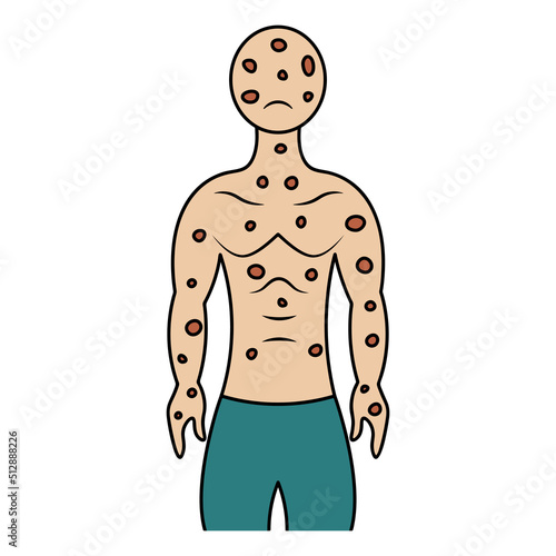 Smallpox on the human body. Color vector illustration. The face and body of the patient is covered with spots. Muscular man is sad. Isolated background. Cartoon style. Medical theme. 