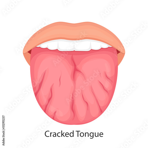Disease of the tongue, cracks. medical illustration.