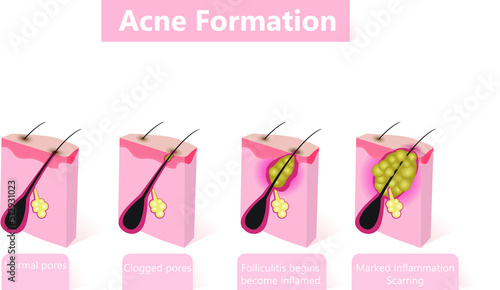 Formation of skin acne or pimple. The sebum in the clogged pore promotes the growth of a certain bacteria. This leads to the redness and inflammation associated with pimples. photo