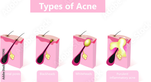 Types of acne pimples. Healthy skin, Whiteheads and Blackheads, Papules and Pustules. photo