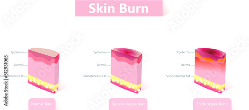 skin burn. Three degrees of burns. 