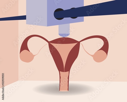 Organ uterus and ovaries in 3D printer, flat vector stock illustration as concept of medical and health care technologies