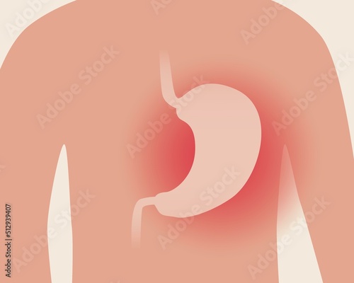 Stomach disease, anatomical vector stock illustration with person and disease gastritis or stomach ulcer