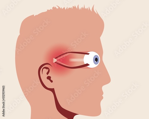 Disease of organs of vision, anatomical vector stock illustration with persona and cataract or glaucoma disease