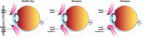 Medical illustration shows the comparison between a normal eye, one affected by entropion and another affected by ectropion.