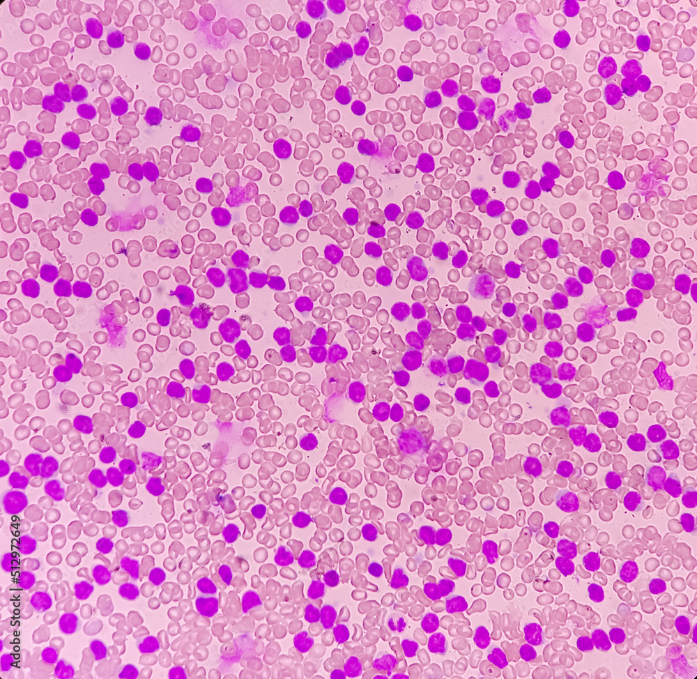 Acute leukemia, peripheral blood smear show most of cell are blast cell with abundant cytoplasm, variable chromatin present.