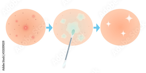 Acne treatment skin problems. Before after. Clean skin icons. Zoom. Flat Cartoon Line style. Vector illustration for beauty and medical design.