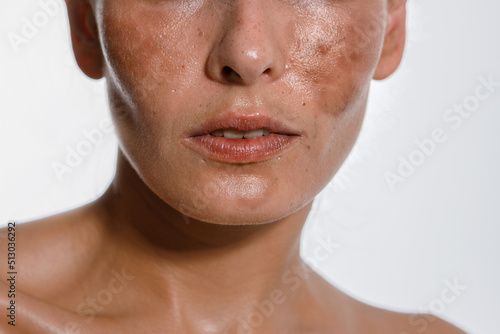 Hyperpigmentation of female skin, close-up of a part of the face on a white background, cosmetology, dermatology, skin care photo