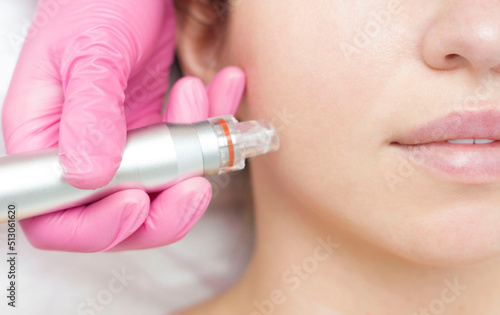 Needle mesotherapy. Cosmetologist performs needle mesotherapy on a womans face. Beautiful woman receiving microneedling rejuvenation treatment. Needle lifting
