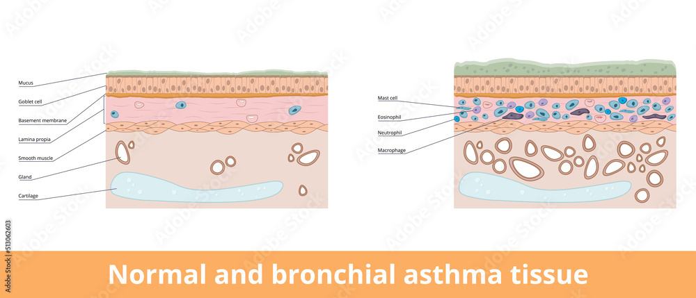 Normal and bronchial asthma tissue. Visualization of difference between normal and bronchial asthma tissues, including goblet cells and smooth muscle, lamina propia and mast cells. - obrazy, fototapety, plakaty 