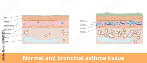Normal and bronchial asthma tissue. Visualization of difference between normal and bronchial asthma tissues, including goblet cells and smooth muscle, lamina propia and mast cells. photo