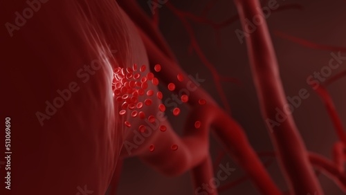 Hemorrhage also known as Internal Bleeding can lead to hemorrhagic stroke