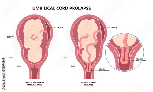 fatal cord with labor delivery of the fetus baby birth twins fluid breech and c section overt funic occult vasa previa obstetrical water breaking transverse lie