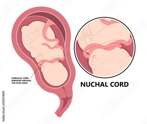 fetus in womb with Vasa previa Nuchal cord coil c section baby birth fetal neck death Knot test born labor fluid Anemia Pre eclampsia gestation distress abruption accreta increta