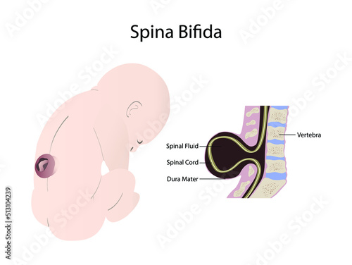 illustration of biology and medical, Illustration of a child with spina bifida, Spina bifida is when a baby's spine and spinal cord