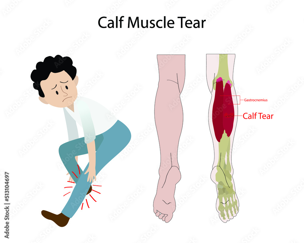 illustration of biology and medical, calf tear and Torn Calf Muscle, A torn  calf muscle is an injury that causes a partial or complete tear in the  muscles behind shin bone Stock