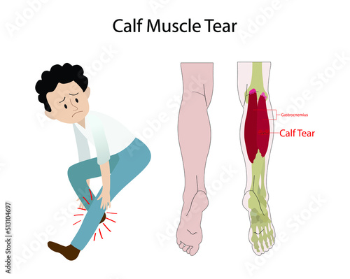 illustration of biology and medical, calf tear and Torn Calf Muscle, A torn calf muscle is an injury that causes a partial or complete tear in the muscles behind shin bone