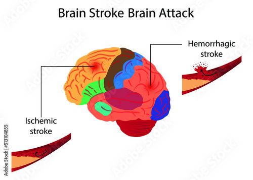 illustration of biology and medical, Brain stroke Brain attack, A stroke is an interruption of the blood supply to any part of the brain, hemorrhagic stroke