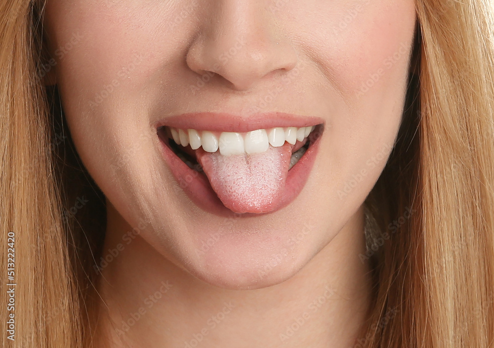 Young woman showing tongue with white patches, closeup. Oral candidiasis (thrush) disease Young woman showing tongue with white patches, closeup. Oral candidiasis (thrush) disease