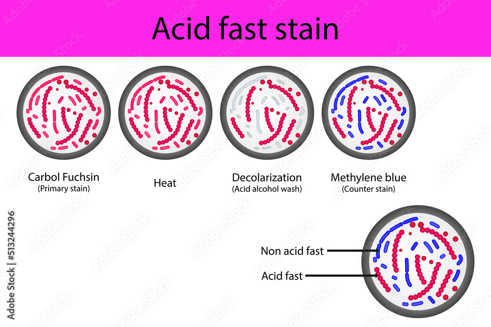 Acid fast staining microbiology lab technique steps diagram, using Carbol fuchsine and methylene blue vector illustration eps10 Acid fast staining microbiology lab technique steps diagram, using Carbol fuchsine and methylene blue vector illustration eps10