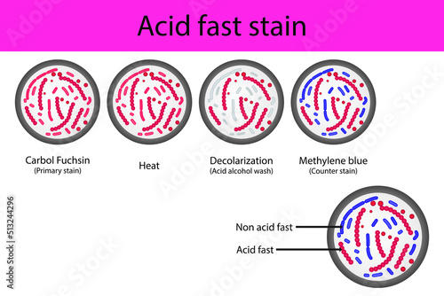 Acid fast staining microbiology lab technique steps diagram, using Carbol fuchsine and methylene blue vector illustration eps10