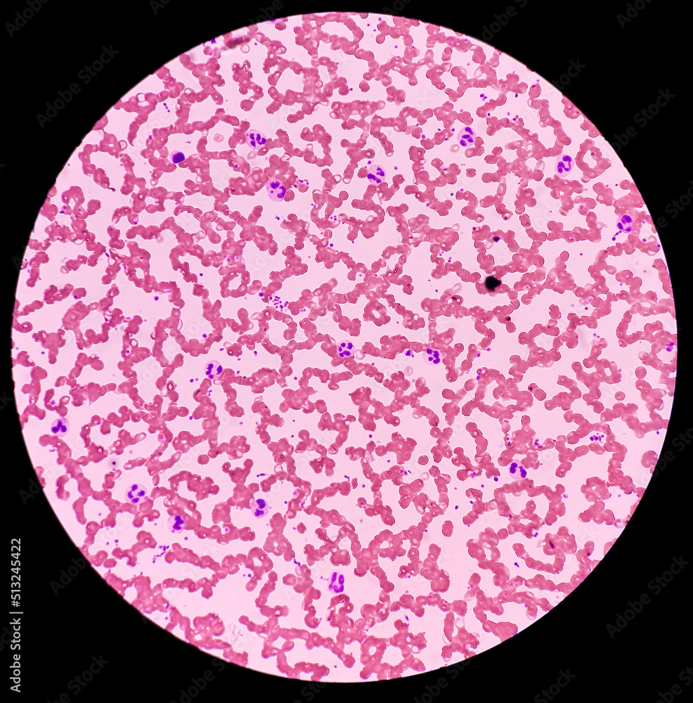 Neutrophilic leukocytosis, increase number of neutrophils caused by