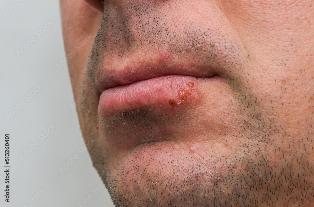 Naklejka premium Sore herpes on the lips of a man