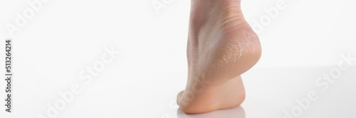 Obraz na płótnie Single female leg or heel showing dried cracked heel with dried skin