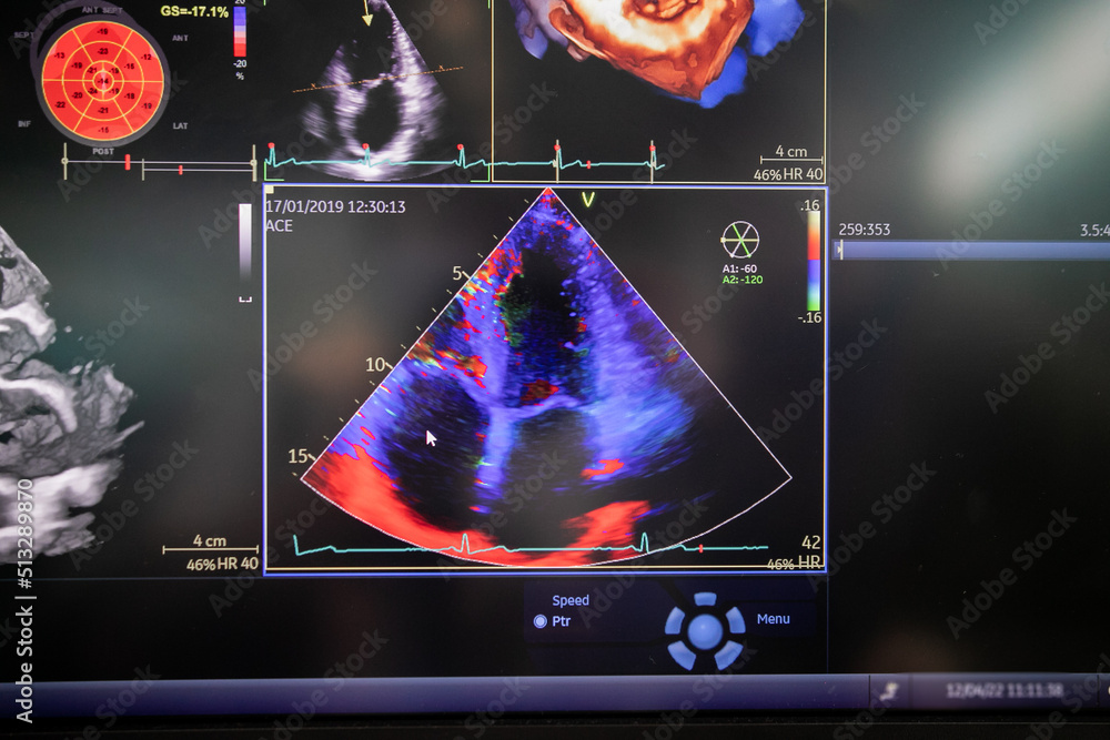 Ultrasound of the heart, Echocardiography (ultrasound) machine Stock